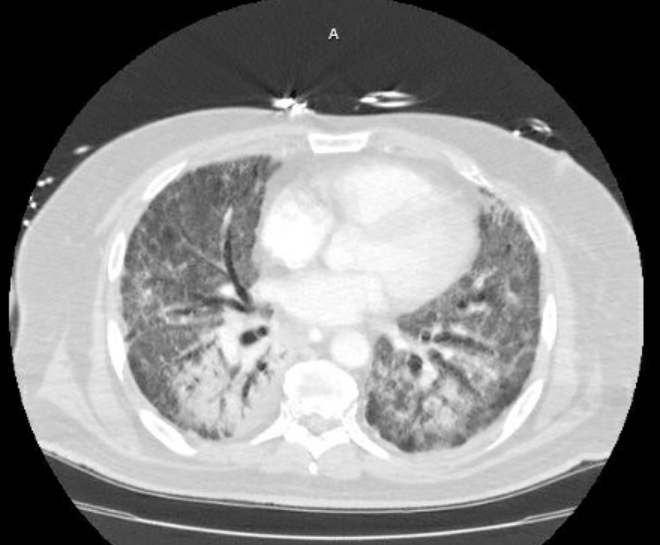 Acute cor pulmonale (ultrasound) (Radiopaedia 83508-98818 Axial lung window 59).jpg