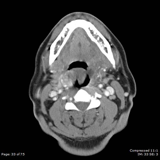 File:Acute epiglottitis (Radiopaedia 54375-60590 Axial 11).jpg