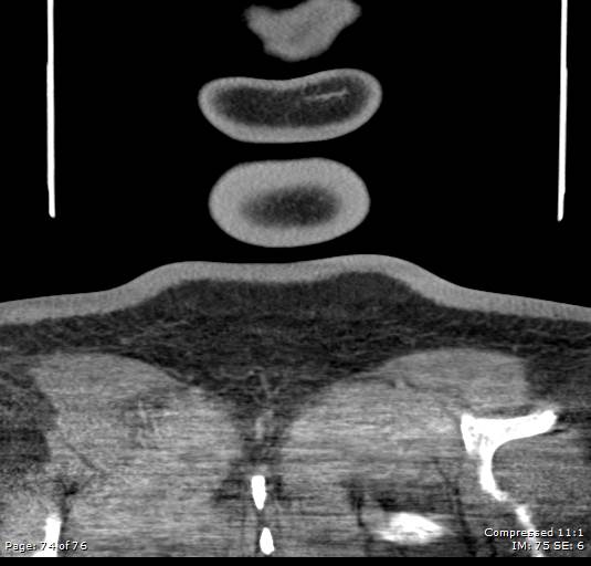 Acute epiglottitis (Radiopaedia 54375-60590 Coronal C+ arterial phase 74).jpg