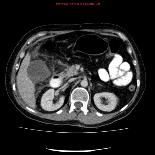 File:Acute gangrenous cholecystitis (Radiopaedia 10123-10661 Axial C+ portal venous phase 35).jpg