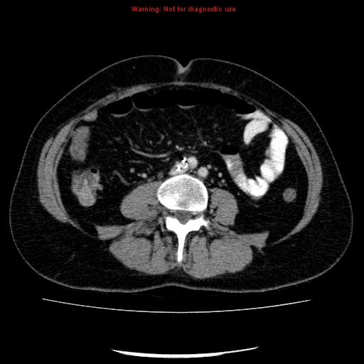 File:Acute gangrenous cholecystitis (Radiopaedia 10123-10661 Axial C+ portal venous phase 62).jpg