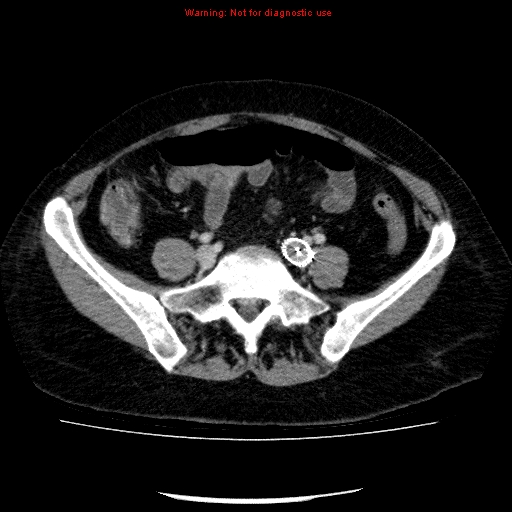 Acute gangrenous cholecystitis (Radiopaedia 10123-10661 Axial C+ portal venous phase 74).jpg