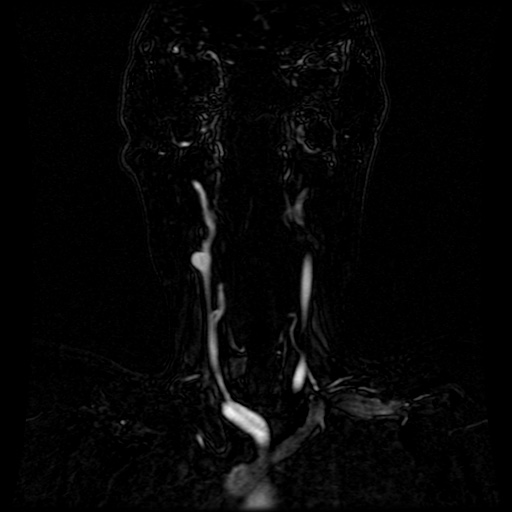 Acute internal carotid artery dissection (Radiopaedia 53541-59632 Coronal MRA 64).jpg