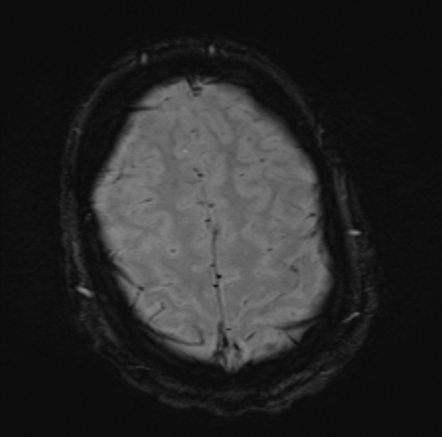 Acute ischemic stroke - posterior circulation territory (Radiopaedia 77670-89880 Axial SWI 48).jpg