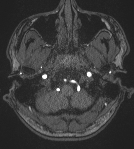 Acute left middle cerebral artery territory infarct with clot retrieval (Radiopaedia 47732-52433 Axial MRA 5).png