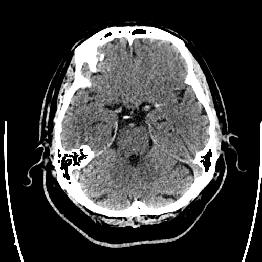 Acute left middle cerebral artery territory ischemic stroke (Radiopaedia 35688-37223 Axial non-contrast 24).png