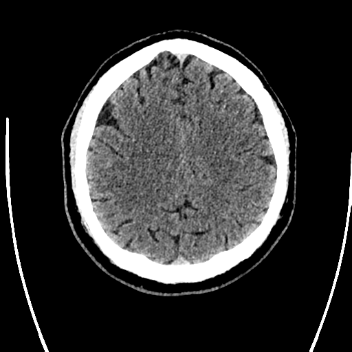 Acute left middle cerebral artery territory ischemic stroke (Radiopaedia 35688-37223 Axial non-contrast 59).png