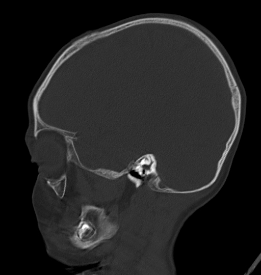 File:Acute mastoiditis (Radiopaedia 82678-96881 Sagittal bone window 17).jpg