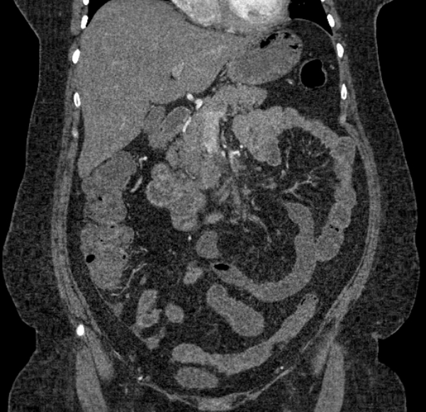 Acute mesenteric ischemia (Radiopaedia 80029-93316 Coronal C+ arterial phase 55).jpg