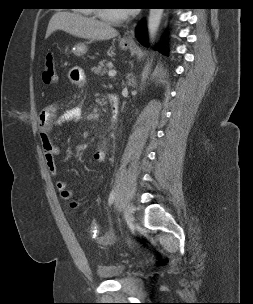 Acute mesenteric venous ischemia (Radiopaedia 46041-50383 Sagittal C+ portal venous phase 68).jpg