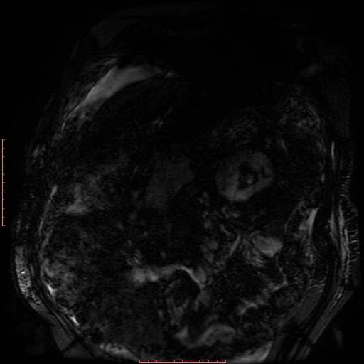 File:Acute necrotizing pancreatitis (Radiopaedia 28194-28448 Coronal MRCP 87).jpg