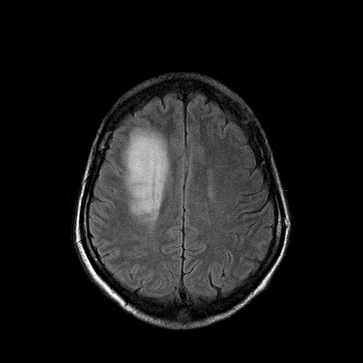 File:Acute necrotizing toxoplasma encephalitis (Radiopaedia 10683-11149 Axial FLAIR 5).jpg