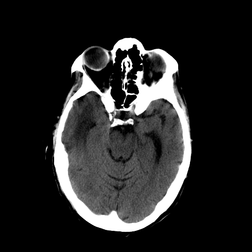 File:Acute necrotizing toxoplasma encephalitis (Radiopaedia 10683-11150 B 21).jpg