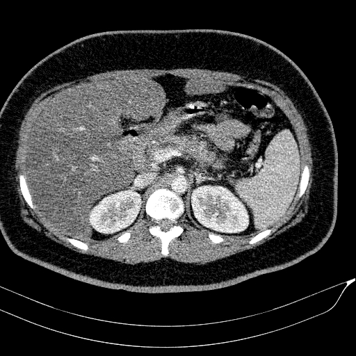 File:Acute on chronic pancreatitis (Radiopaedia 80902-94423 Axial C+ portal venous phase 52).jpg