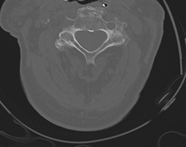 Acute on chronic subdural hematoma and thoracic vertebral injury in a multitrauma patient (Radiopaedia 31698-32619 Axial bone window 24).jpg