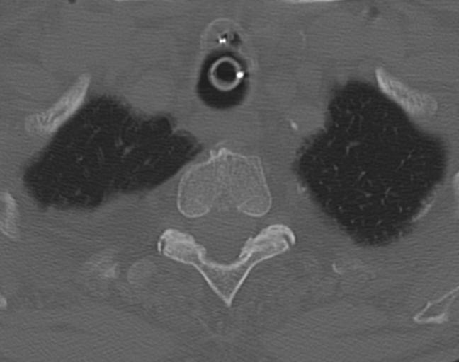 Acute on chronic subdural hematoma and thoracic vertebral injury in a multitrauma patient (Radiopaedia 31698-32619 Axial bone window 60).jpg