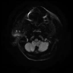 Acute otitis externa (Radiopaedia 57296-64236 Axial DWI 10).jpg