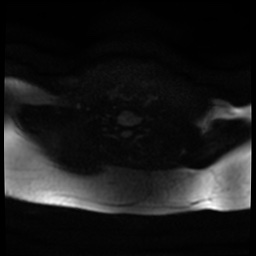 Acute otitis externa (Radiopaedia 57296-64236 Axial DWI 28).jpg