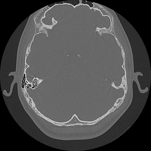 Acute otomastoiditis and Bezold abscess (Radiopaedia 88184-104786 Axial bone window 48).jpg
