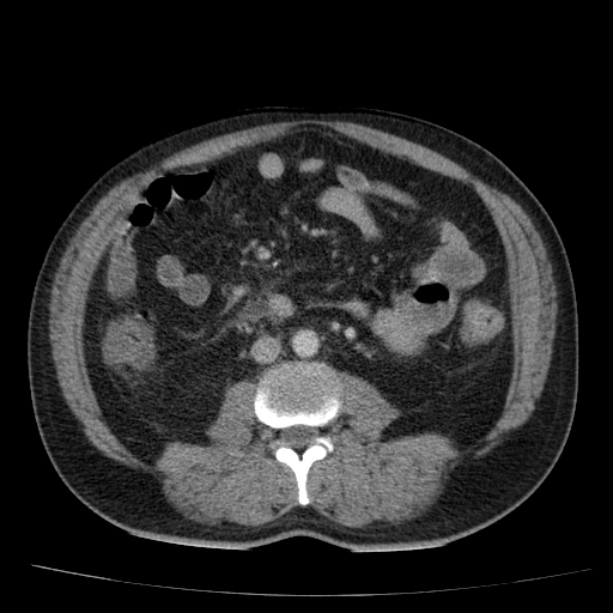 Acute pancreatitis (Radiopaedia 26663-26813 Axial C+ portal venous phase 49).jpg