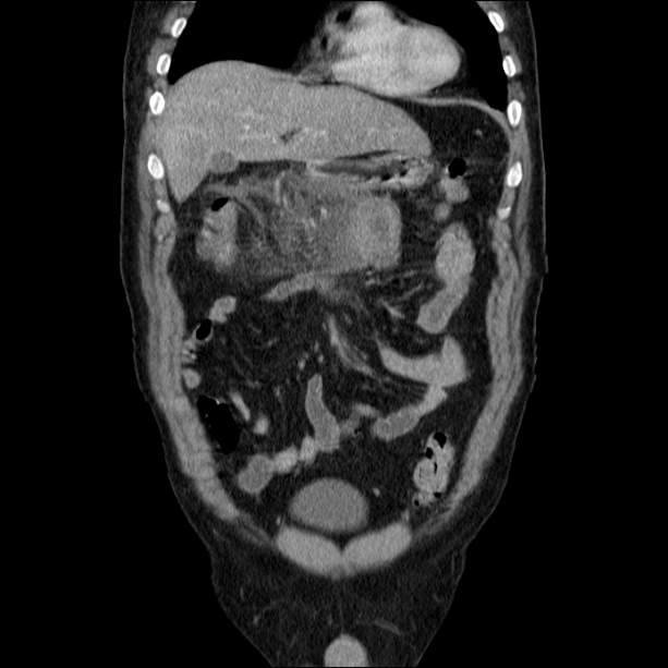 Acute pancreatitis (Radiopaedia 26663-26813 Coronal C+ portal venous phase 19).jpg