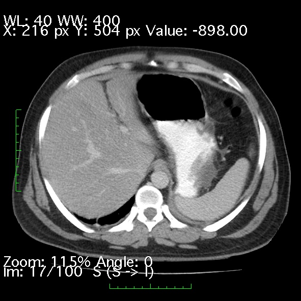 Acute pancreatitis (Radiopaedia 34043-35276 Axial C+ portal venous phase 17).jpg