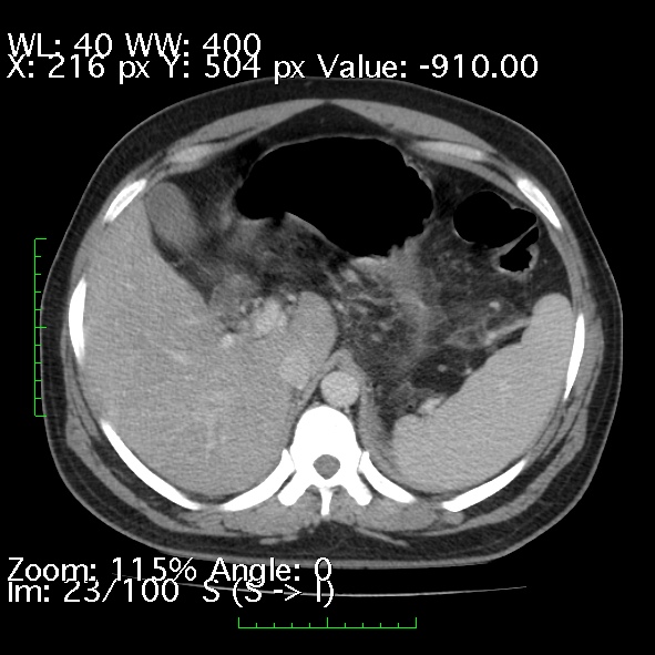 File:Acute pancreatitis (Radiopaedia 34043-35276 Axial C+ portal venous phase 23).jpg