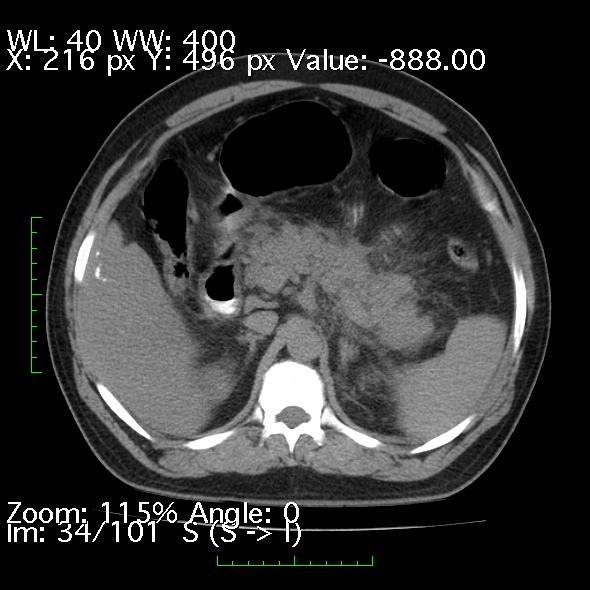 Acute pancreatitis (Radiopaedia 34043-35276 Axial non-contrast 34).jpg