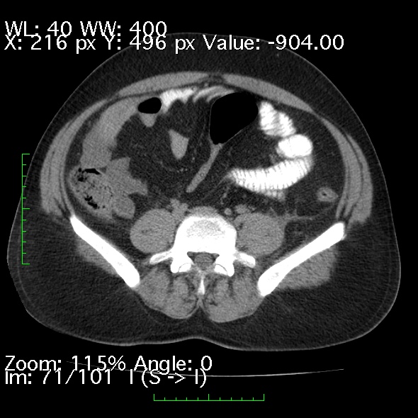Acute pancreatitis (Radiopaedia 34043-35276 Axial non-contrast 71).jpg