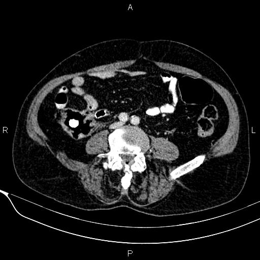 Acute pancreatitis (Radiopaedia 85146-100701 Axial C+ portal venous phase 43).jpg