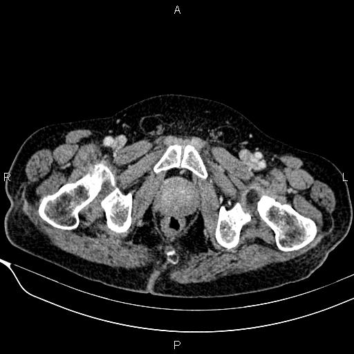 Acute pancreatitis (Radiopaedia 85146-100701 Axial C+ portal venous phase 64).jpg