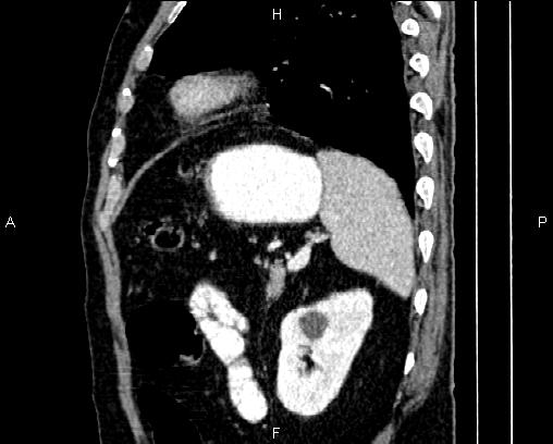 File:Acute pancreatitis (Radiopaedia 85146-100701 Sagittal C+ portal venous phase 74).jpg