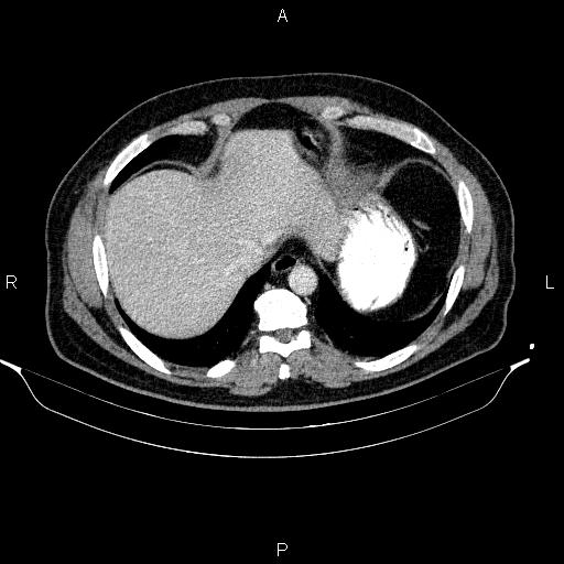 Acute pancreatitis (Radiopaedia 85390-101010 Axial C+ portal venous phase 13).jpg