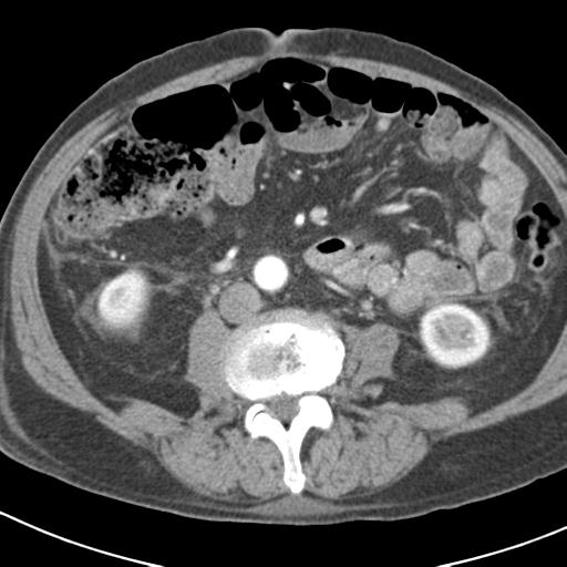 File:Acute pancreatitis and walled-off necrosis (Radiopaedia 29888-30403 Axial C+ portal venous phase 32).jpg