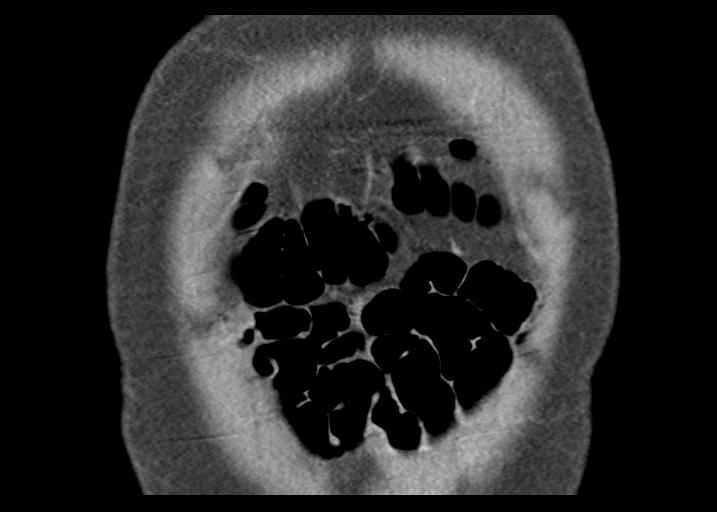 Acute pancreatitis and walled-off necrosis (Radiopaedia 29888-30403 Coronal C+ portal venous phase 9).jpg