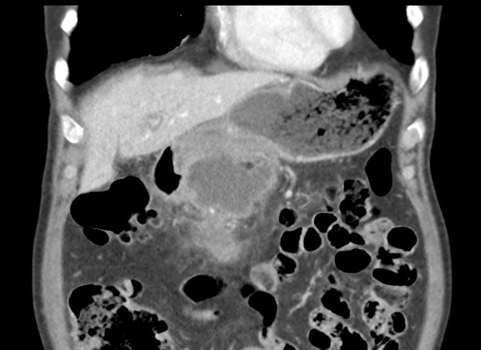 Acute pancreatitis and walled-off necrosis (Radiopaedia 29888-30404 Coronal C+ portal venous phase 15).jpg