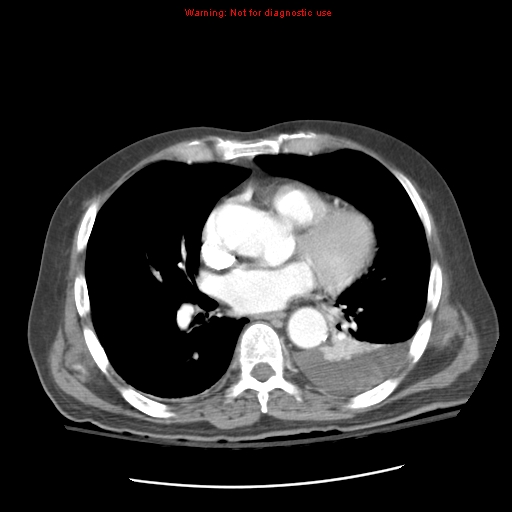 Acute pancreatitis with incidental pancreatic lipoma (Radiopaedia 10190-10730 Axial C+ arterial phase 1).jpg
