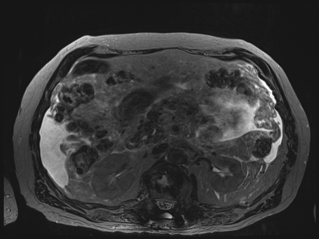 Acute portal vein thrombosis (Radiopaedia 73198-83925 Axial Heavily T2 thin cuts 47).jpg