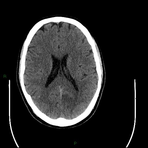 File:Acute posterior cerebral artery territory infarct (Radiopaedia 79329-92393 Axial non-contrast 64).jpg