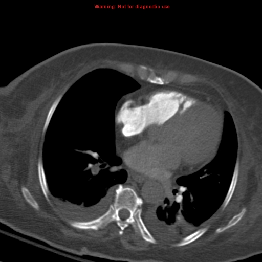Acute pulmonary embolism (Radiopaedia 13286-13289 Axial C+ CTPA 40).jpg