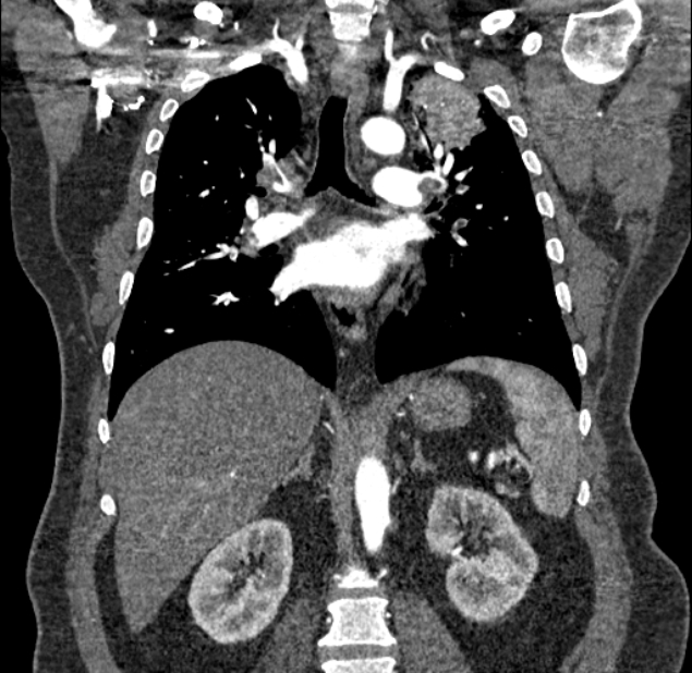 Acute pulmonary embolism with pulmonary infarcts (Radiopaedia 77688-89908 Coronal C+ CTPA 55).jpg