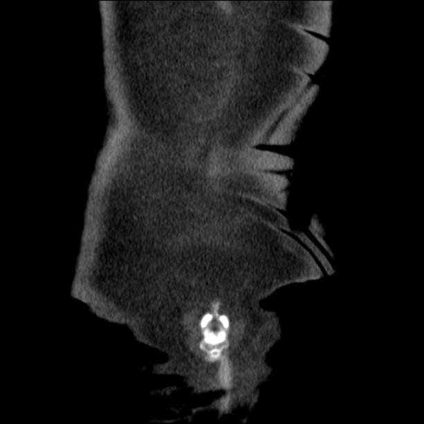 Acute pyelonephritis (Radiopaedia 26584-26729 C+ portal venous phase 73).jpg