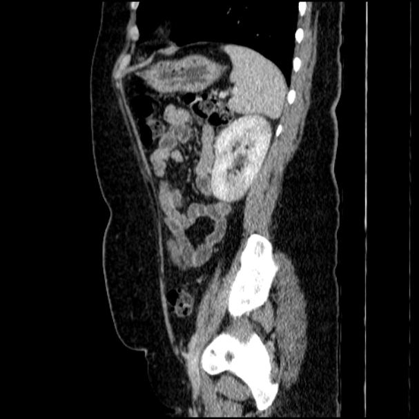 Acute pyelonephritis (Radiopaedia 33397-34434 Sagittal renal parenchymal phase 65).jpg