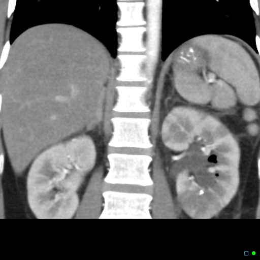 File:Acute pyelonephritis and emphysematous pyonephrosis (Radiopaedia 27893-28128 Coronal renal cortical phase 10).jpg