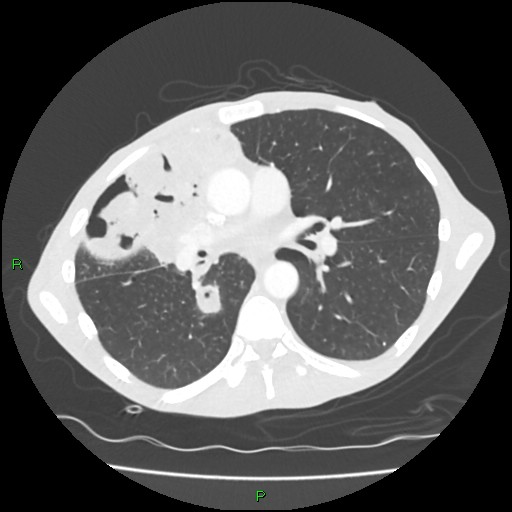 Acute right lung abscess (Radiopaedia 34806-36258 Axial lung window 92).jpg
