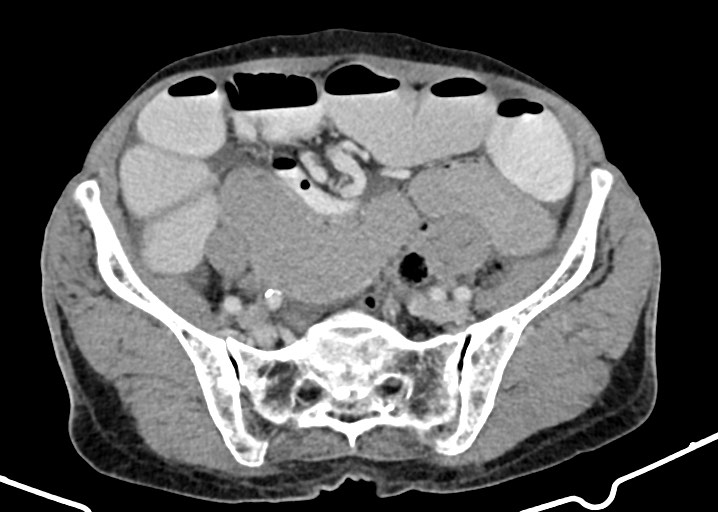 File:Acute small bowel (ileal) volvulus (Radiopaedia 71740-82139 Axial C+ portal venous phase 149).jpg