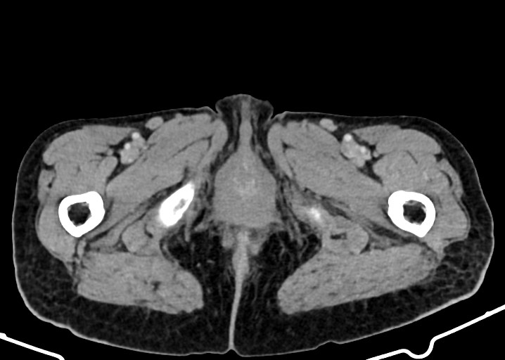 Acute small bowel (ileal) volvulus (Radiopaedia 71740-82139 Axial C+ portal venous phase 219).jpg