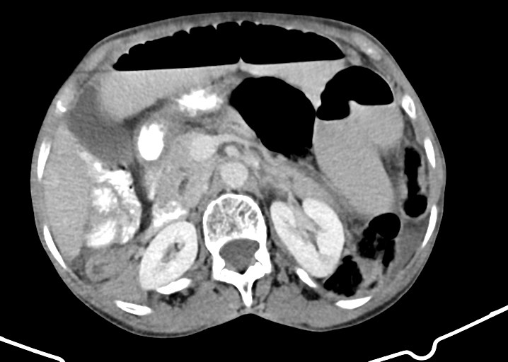 Acute small bowel (ileal) volvulus (Radiopaedia 71740-82139 Axial C+ portal venous phase 80).jpg