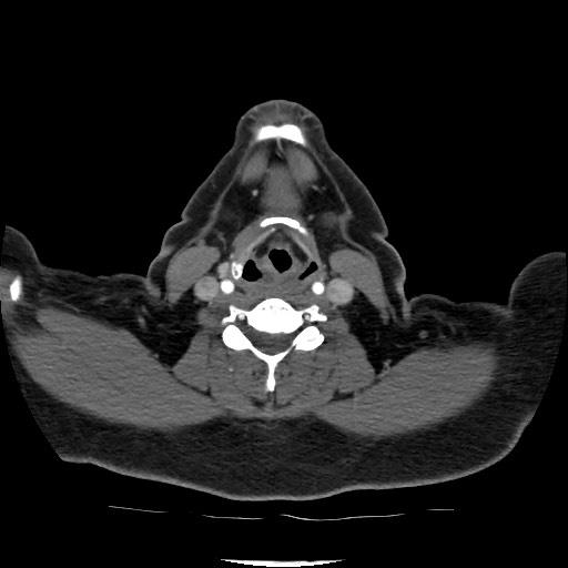 Acute subarachnoid hemorrhage and accessory anterior cerebral artery (Radiopaedia 69231-79009 Axial C+ arterial phase 45).jpg