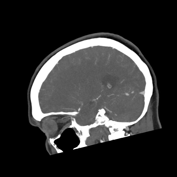 Acute subarachnoid hemorrhage and accessory anterior cerebral artery (Radiopaedia 69231-79009 Sagittal C+ arterial phase 48).jpg